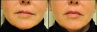 Belotero for Lip Augmentation