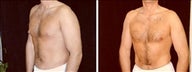 35 year old male, male breast reduction
