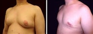 33 year old male, male breast reduction