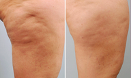 Cellulaze