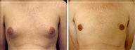 21 year old male, male breast reduction