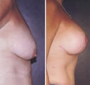 Breast Lift
