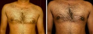 26 year old male, male breast reduction