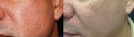 IPL Before and After Photos