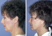 Face lift with chin implant side view
