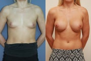 Breast Implants over muscle 375cc