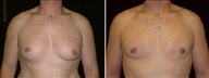32 year old male, male breast reduction