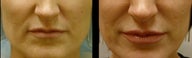 Juvederm for Lip Augmentation