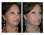 Juvederm for Nasolabial Folds