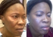 Eye Bags Treatment