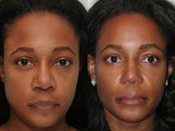 African American Rhinoplasty
