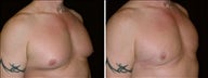 50 year old male, male breast reduction
