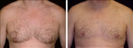 42 year old male, male breast reduction
