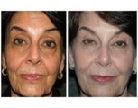 Liquid Facelift