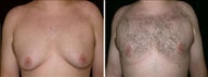 18 year old male, male breast reduction