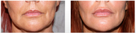 Restylane Treatment in the Lips