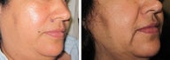 Mole Removal photos