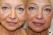 Silikon-1000 treatment to nasolabial folds, marionette wrinkles, and lips. Botox for frown lines.