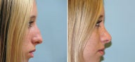Rhinoplasty
