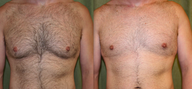 Gynecomastia surgery - male breast reduction