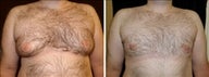 31 year old male, male breast reduction