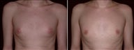 19 year old male, male breast reduction