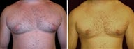 24 year old male, male breast reduction