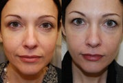 Silikon-1000 treatment for nasolabial folds