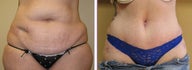 Liposuction