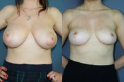 Breast Reduction