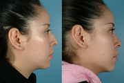Revision Rhinoplasty