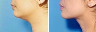 Chin Liposuction