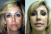 Cheek Augmentation