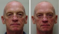 Eyelid Surgery
