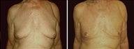 77 year old male, male breast reduction