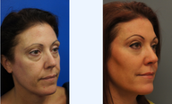Fat Transfer to the Face