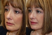 Silikon-1000 for undereyes, nasolabial folds, lips, and corners of mouth.
