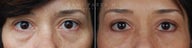 Before and After lower eyelid revisional blepharoplasty