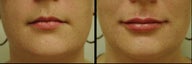 Juvederm for Lip Augmentation