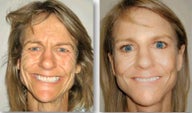 Facelift