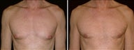 49 Year Old Male, male breast reduction