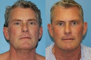 Exilis face male