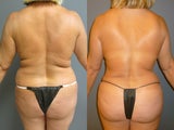 48 year old female present for a Brazilian Butt Lift