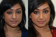 Rhinoplasty Surgery. 6 months post-op.