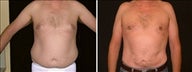 55 year old male, male breast reduction
