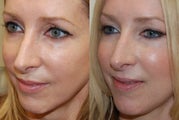 Silikon-1000 treatments to lower eyelid grooves and cheeks. Botox.