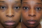 Lower eyelid rejuvenation with Silikon-1000. One treatment.
