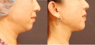 Chin Liposuction