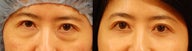 Lower eyelid surgery