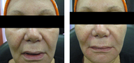 Sculptra
